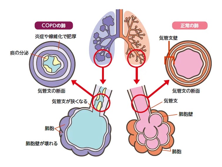 正常な肺とCOPDの肺のイラスト